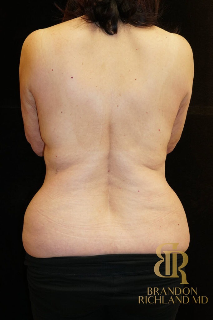 Tummy Tuck Before, Patient 13, view 4 — Dr. Brandon Richland, Newport Beach