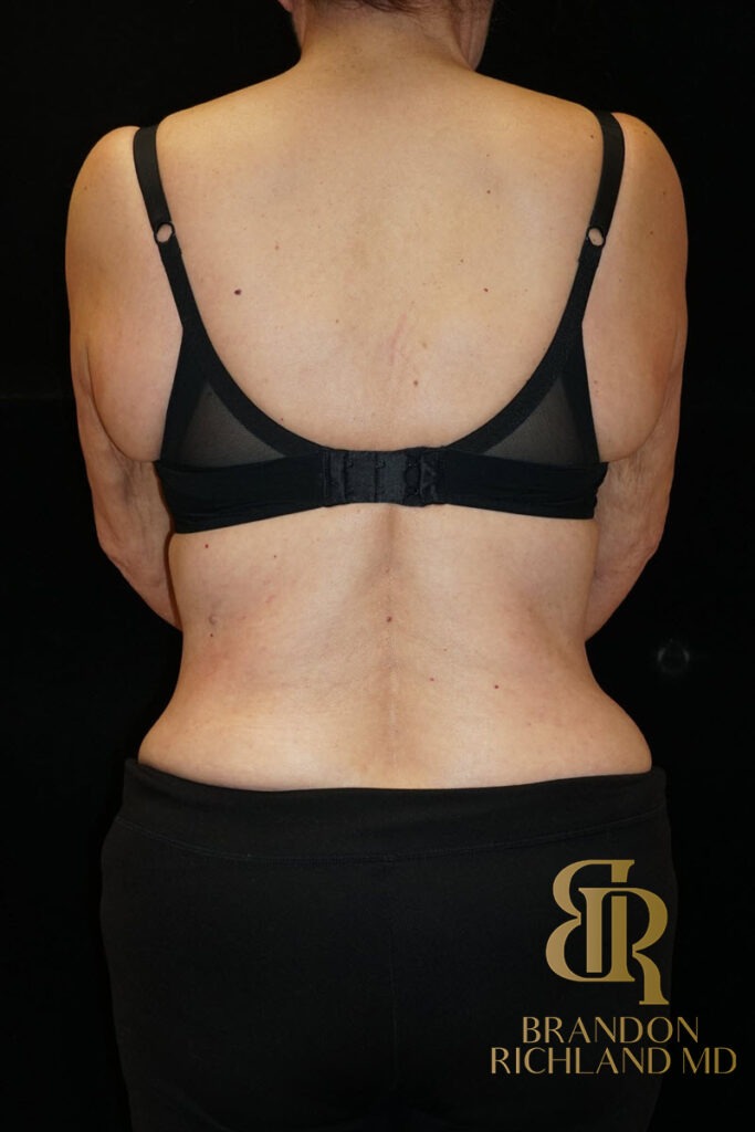 Tummy Tuck After, Patient 13, view 4 — Dr. Brandon Richland, Newport Beach