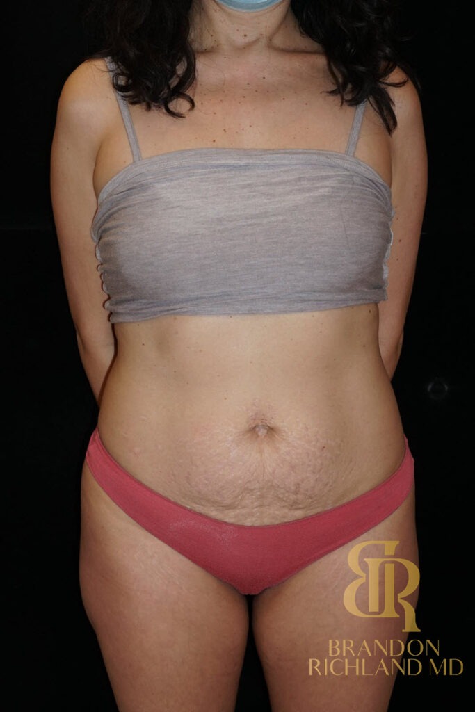 Tummy Tuck Before, Patient 15, view 1 — Dr. Brandon Richland, Newport Beach