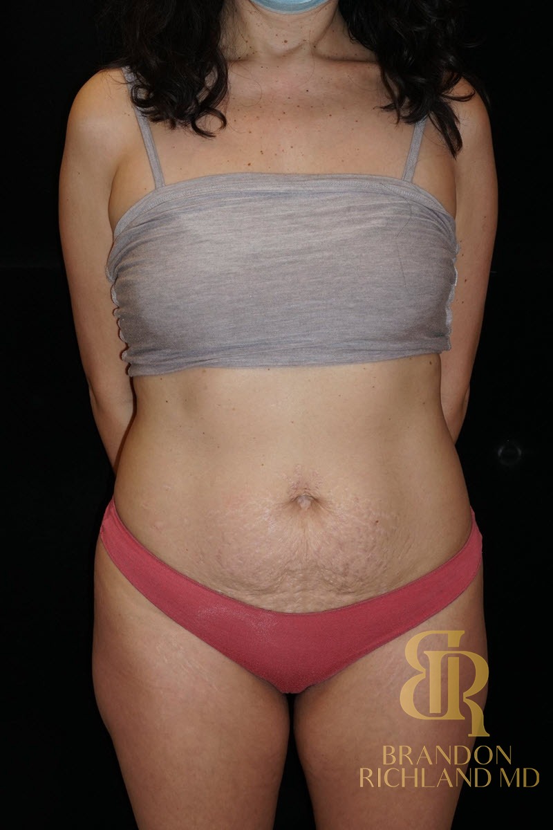 Tummy Tuck before and after, Patient 15 — Dr. Brandon Richland, Newport Beach