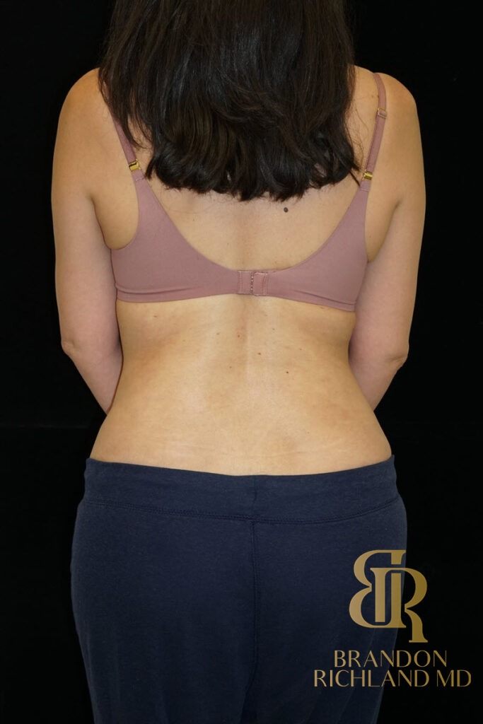 Tummy Tuck After, Patient 15, view 4 — Dr. Brandon Richland, Newport Beach