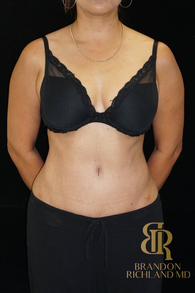 Tummy Tuck After, Patient 16, view 1 — Dr. Brandon Richland, Newport Beach