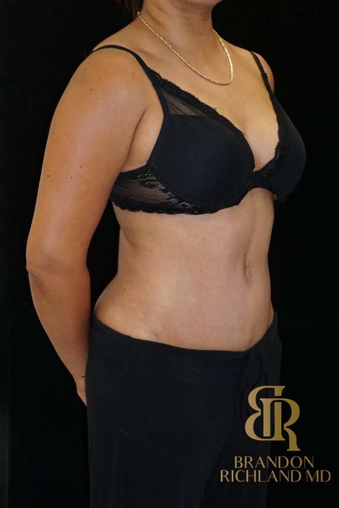 Tummy Tuck After, Patient 16, view 2 — Dr. Brandon Richland, Newport Beach