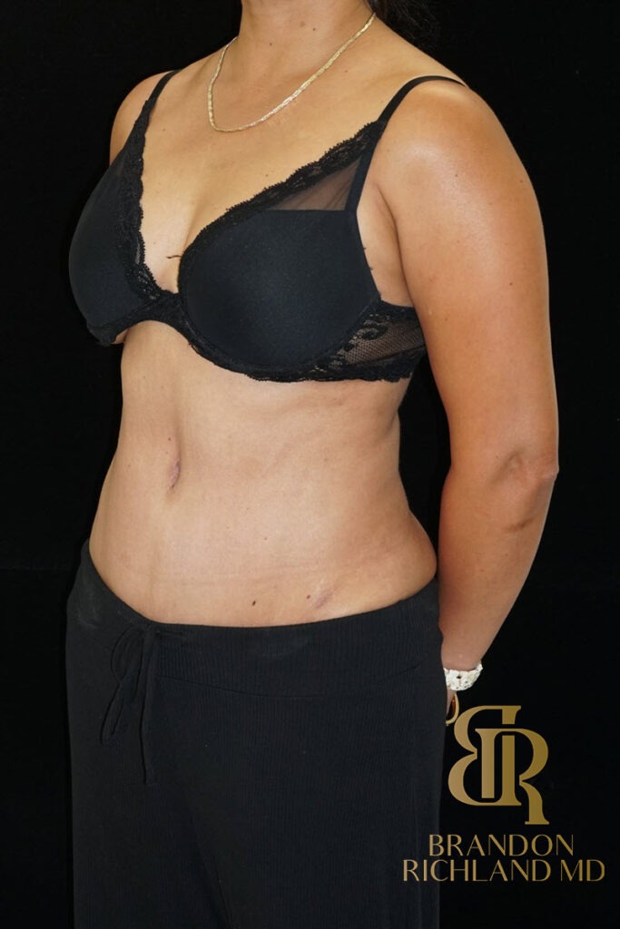 Tummy Tuck After, Patient 16, view 4 — Dr. Brandon Richland, Newport Beach
