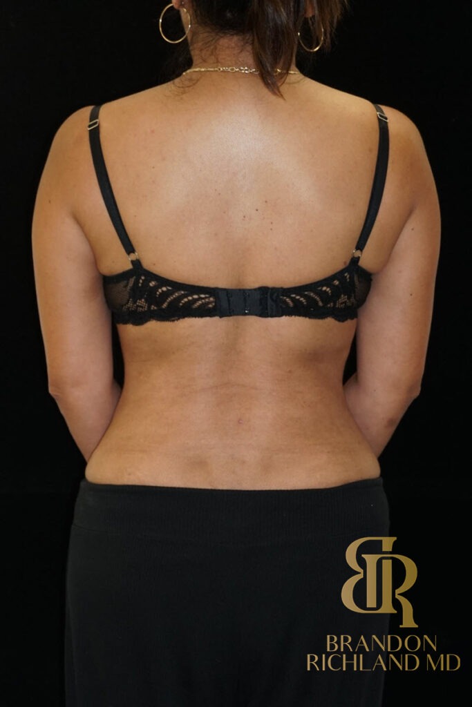 Tummy Tuck After, Patient 16, view 6 — Dr. Brandon Richland, Newport Beach