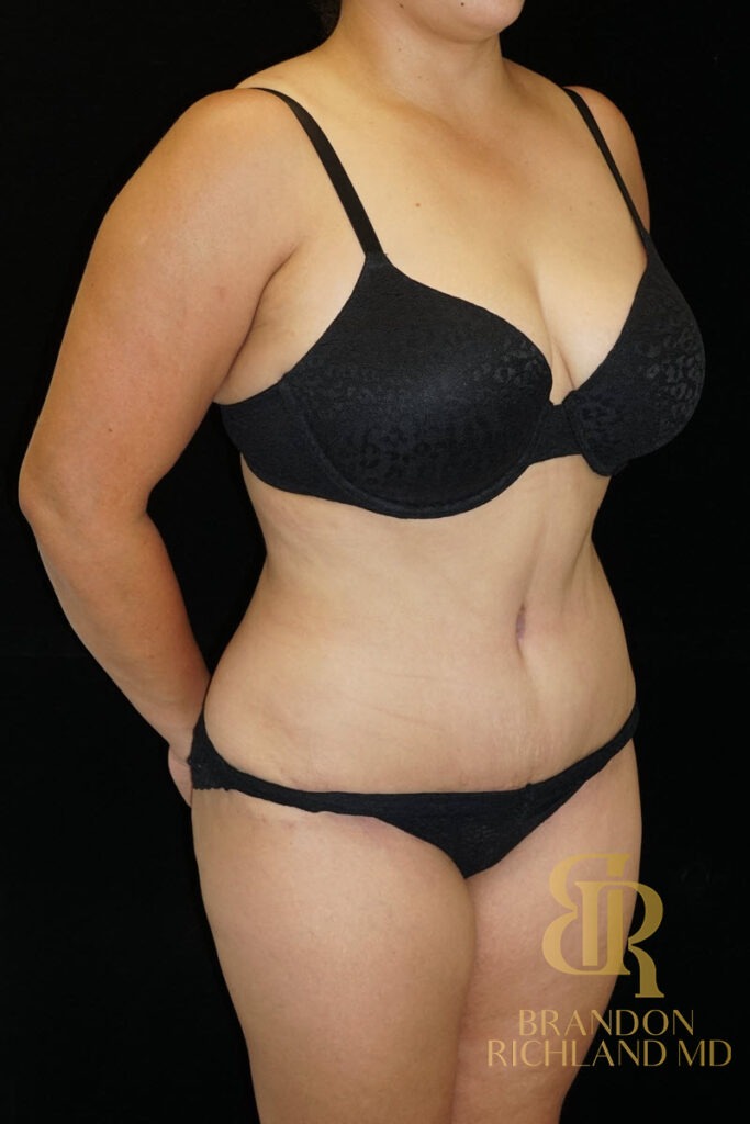 Tummy Tuck After, Patient 17, view 2 — Dr. Brandon Richland, Newport Beach