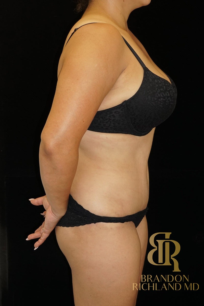 Tummy Tuck before and after, Patient 17 — Dr. Brandon Richland, Newport Beach