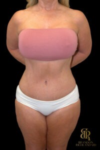 Tummy Tuck before and after, Case #18534 — Dr. Brandon Richland, Newport Beach
