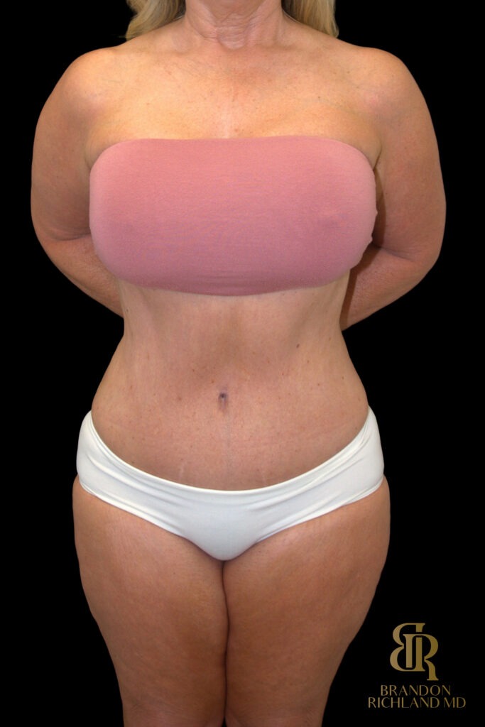 Tummy Tuck After, Case #18534, view 1 — Dr. Brandon Richland, Newport Beach