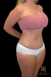 Tummy Tuck before and after, Case #18534 — Dr. Brandon Richland, Newport Beach