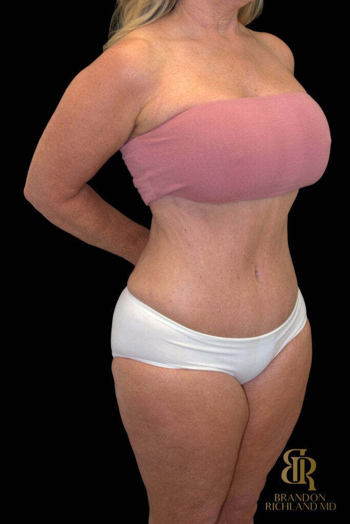 Tummy Tuck After, Case #18534, view 2 — Dr. Brandon Richland, Newport Beach