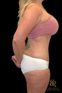 Tummy Tuck before and after, Case #18534 — Dr. Brandon Richland, Newport Beach