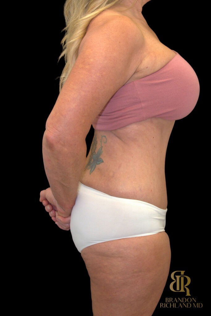 Tummy Tuck After, Case #18534, view 3 — Dr. Brandon Richland, Newport Beach