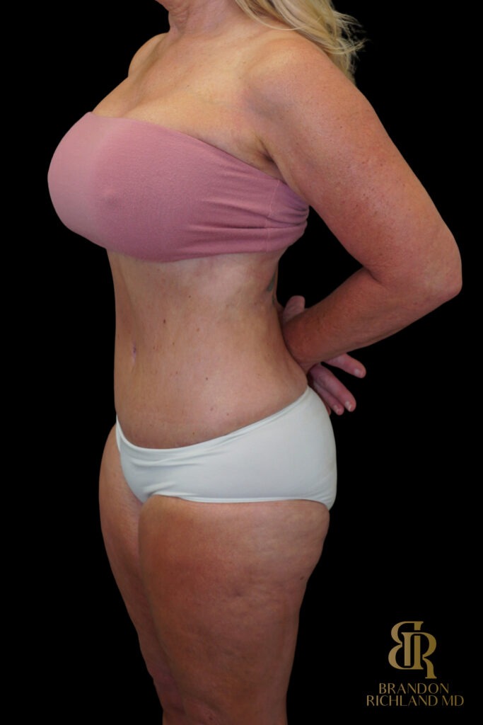 Tummy Tuck After, Case #18534, view 4 — Dr. Brandon Richland, Newport Beach