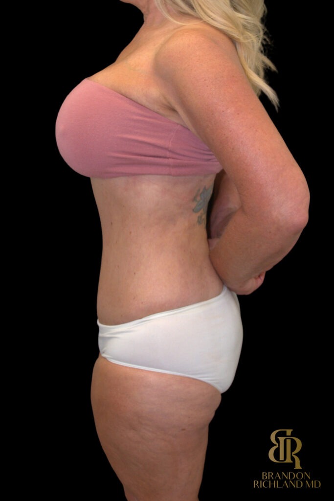 Tummy Tuck After, Case #18534, view 5 — Dr. Brandon Richland, Newport Beach