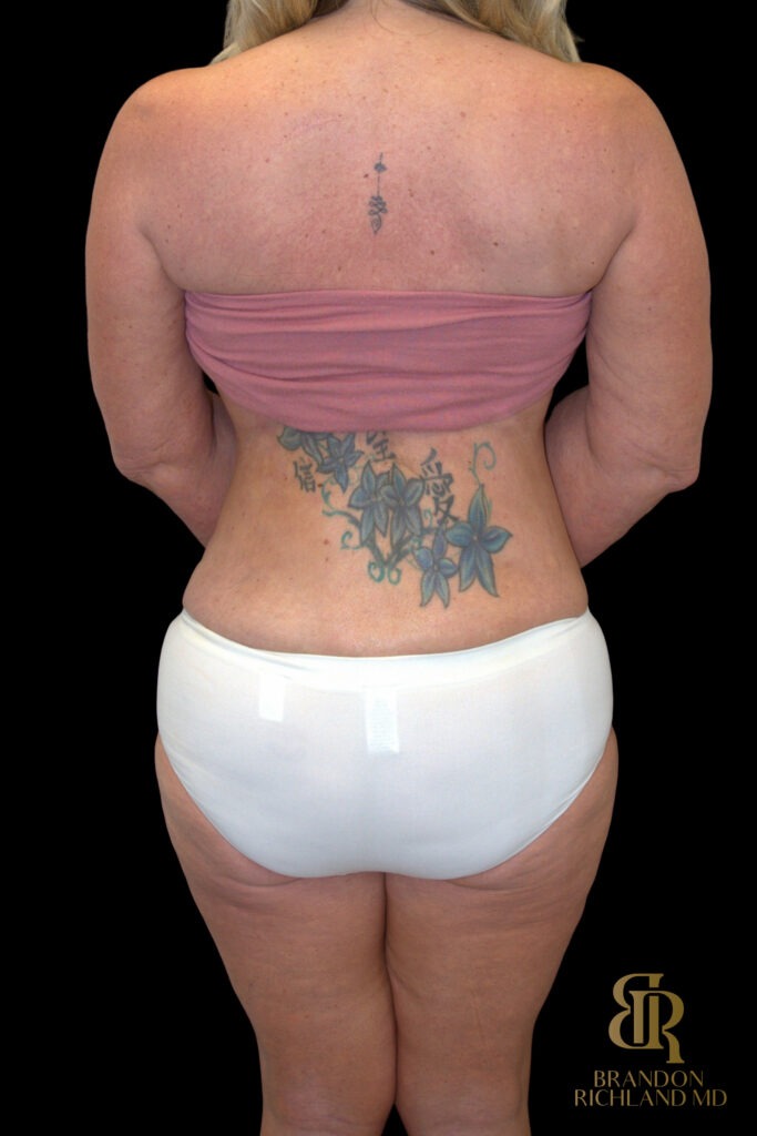 Tummy Tuck After, Case #18534, view 6 — Dr. Brandon Richland, Newport Beach