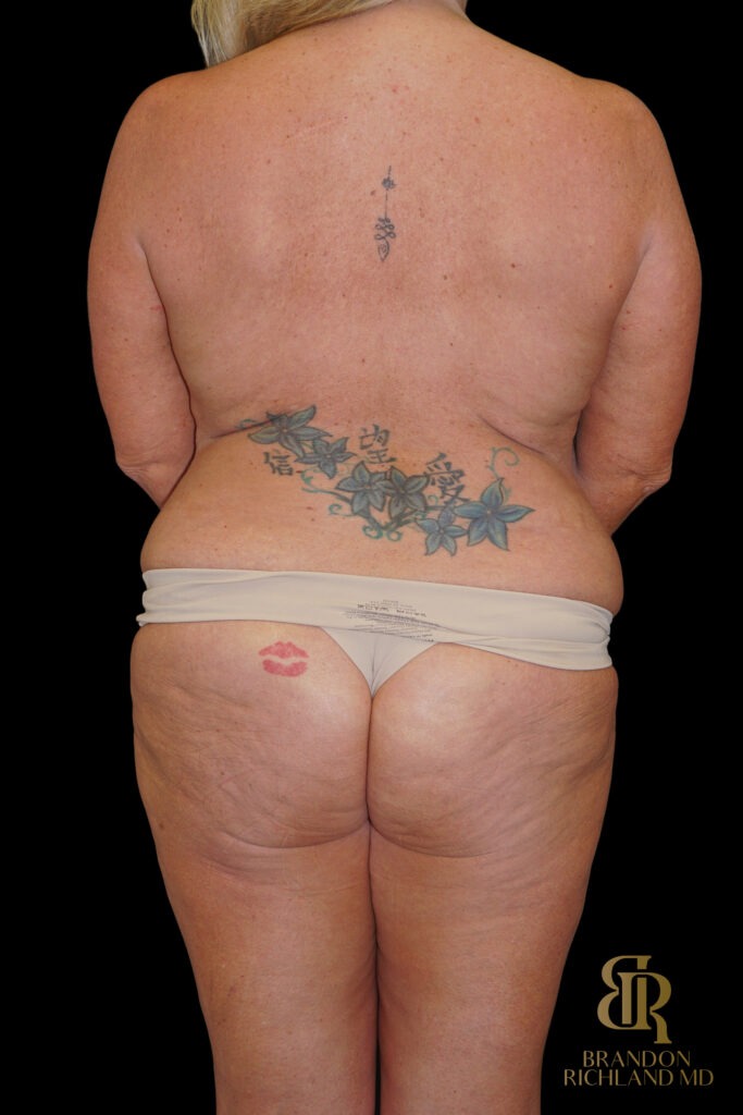 Tummy Tuck Before, Case #18534, view 6 — Dr. Brandon Richland, Newport Beach
