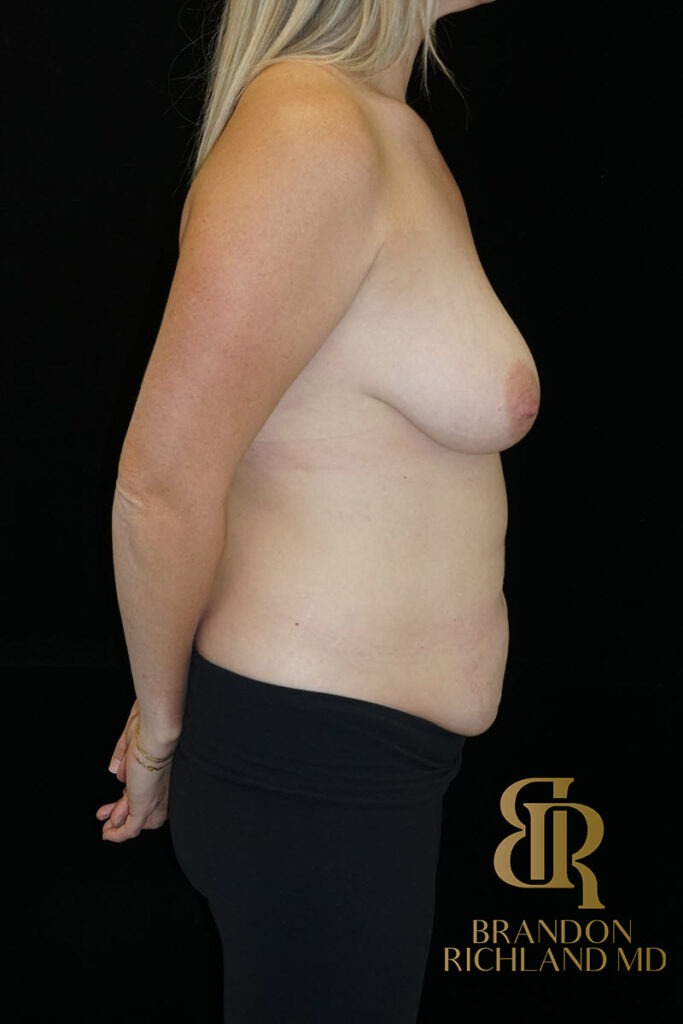 Tummy Tuck Before, Patient 19, view 3 — Dr. Brandon Richland, Newport Beach