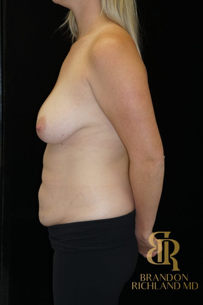 Tummy Tuck Before, Patient 19, view 5 — Dr. Brandon Richland, Newport Beach
