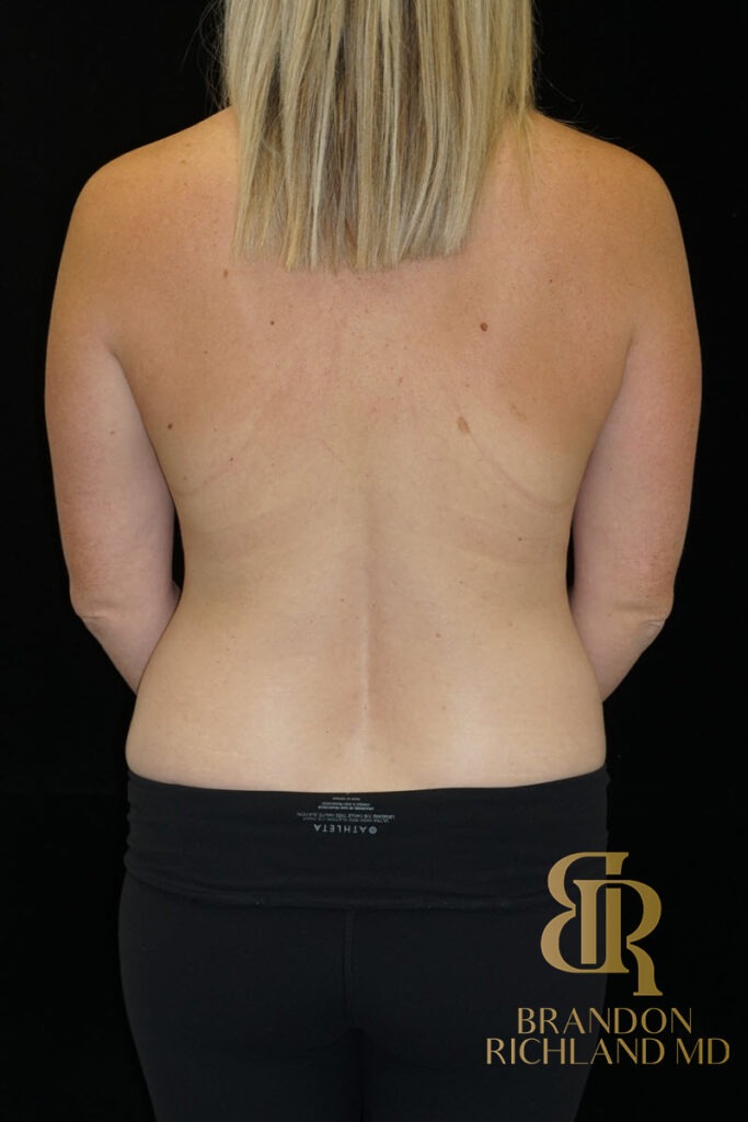 Tummy Tuck Before, Patient 19, view 6 — Dr. Brandon Richland, Newport Beach