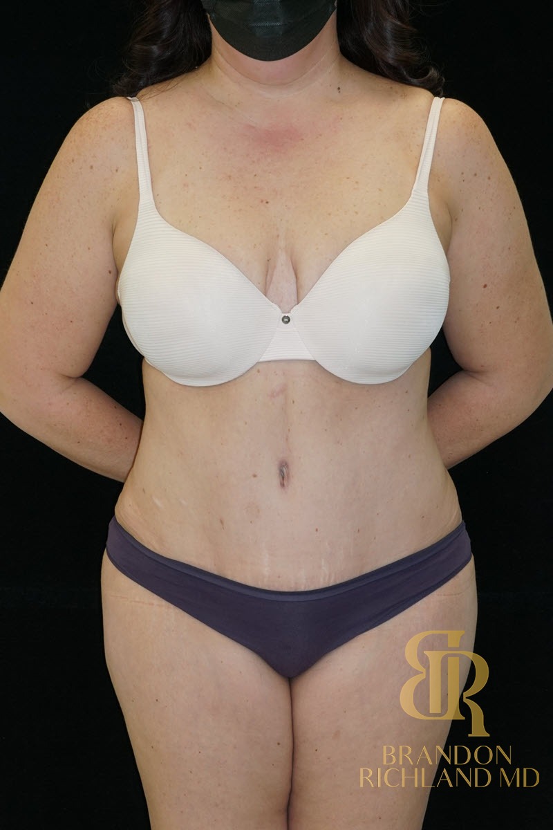 Tummy Tuck before and after, Patient 22 — Dr. Brandon Richland, Newport Beach