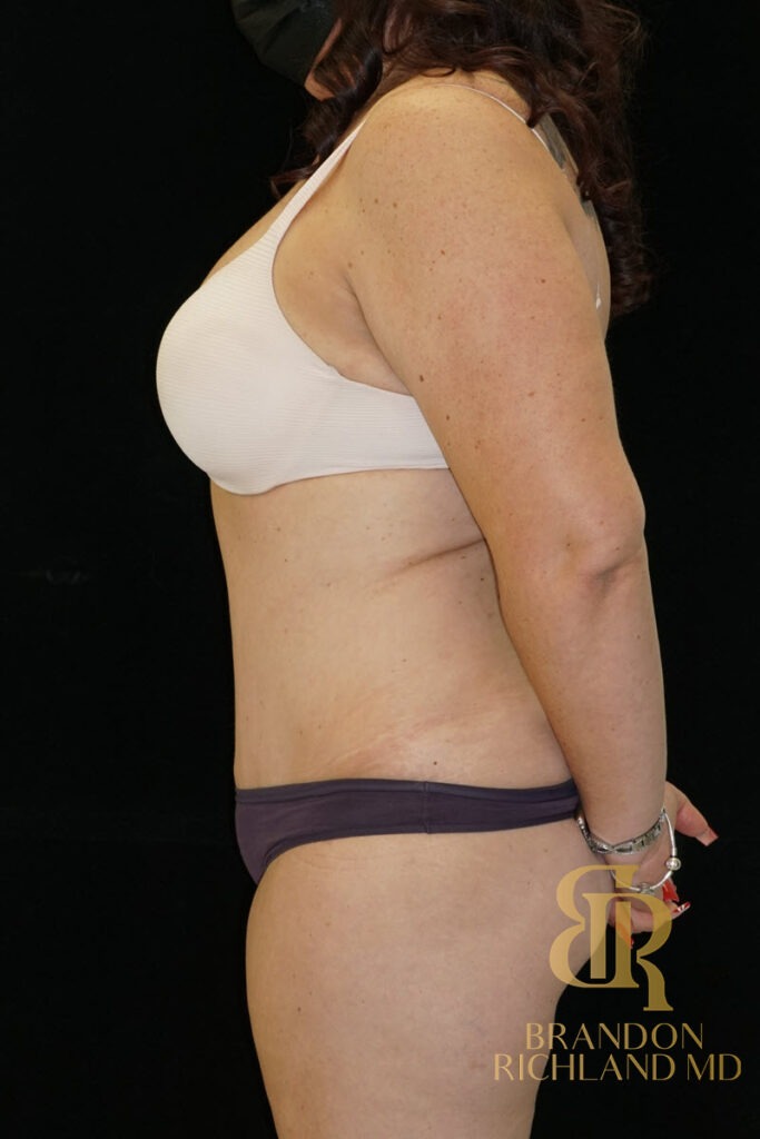 Tummy Tuck After, Patient 22, view 5 — Dr. Brandon Richland, Newport Beach