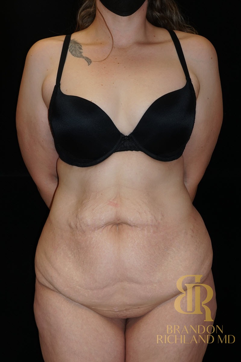 Tummy Tuck before and after, Patient 26 — Dr. Brandon Richland, Newport Beach