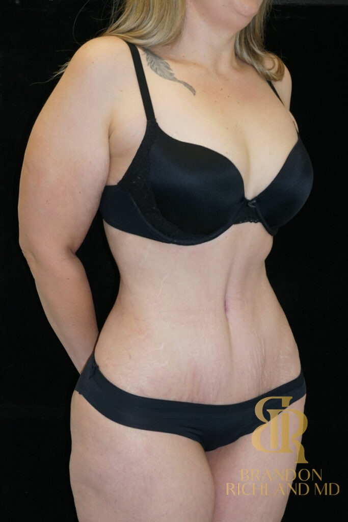 Tummy Tuck After, Patient 26, view 2 — Dr. Brandon Richland, Newport Beach
