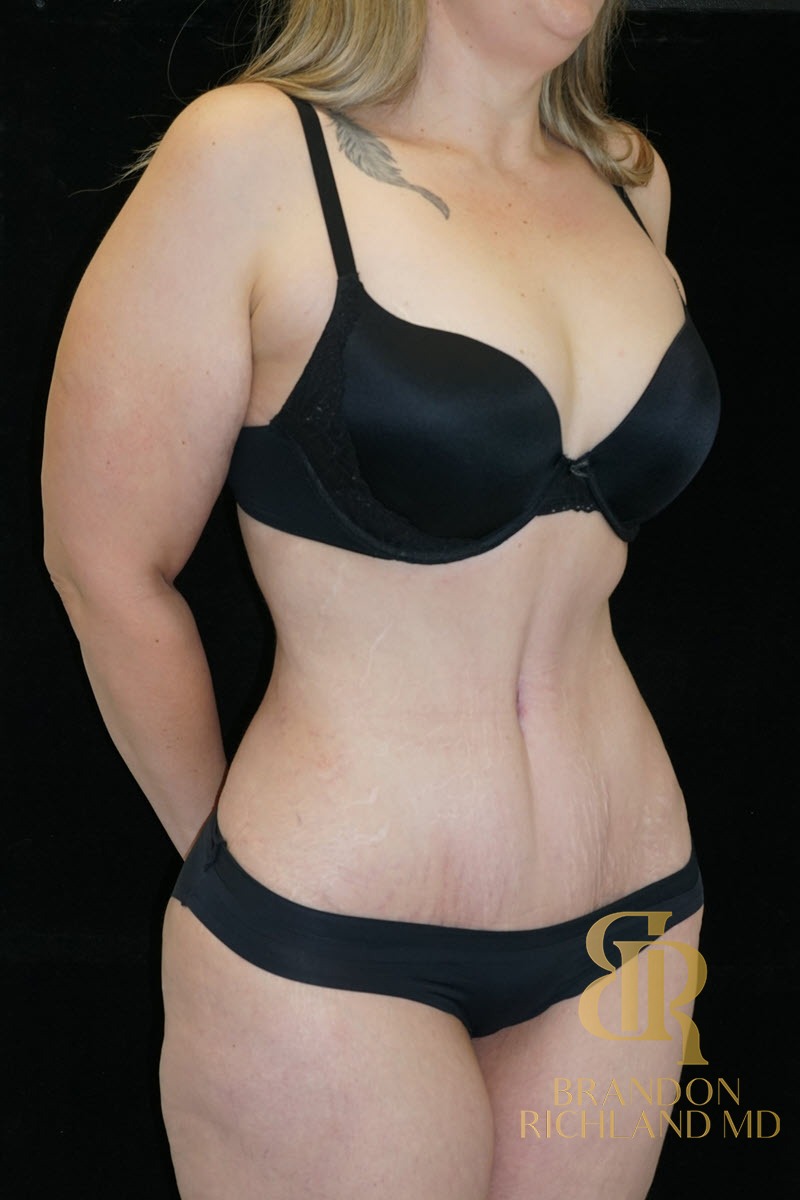 Tummy Tuck before and after, Patient 26 — Dr. Brandon Richland, Newport Beach
