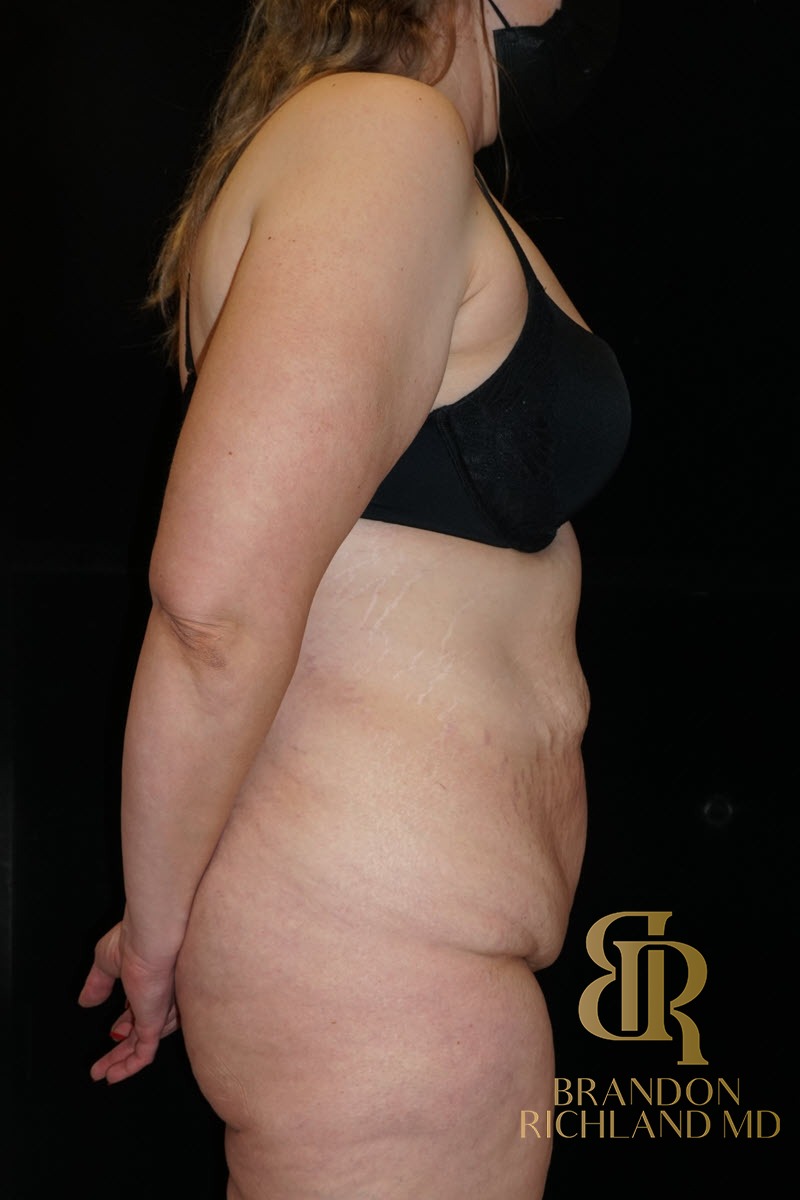 Tummy Tuck before and after, Patient 26 — Dr. Brandon Richland, Newport Beach