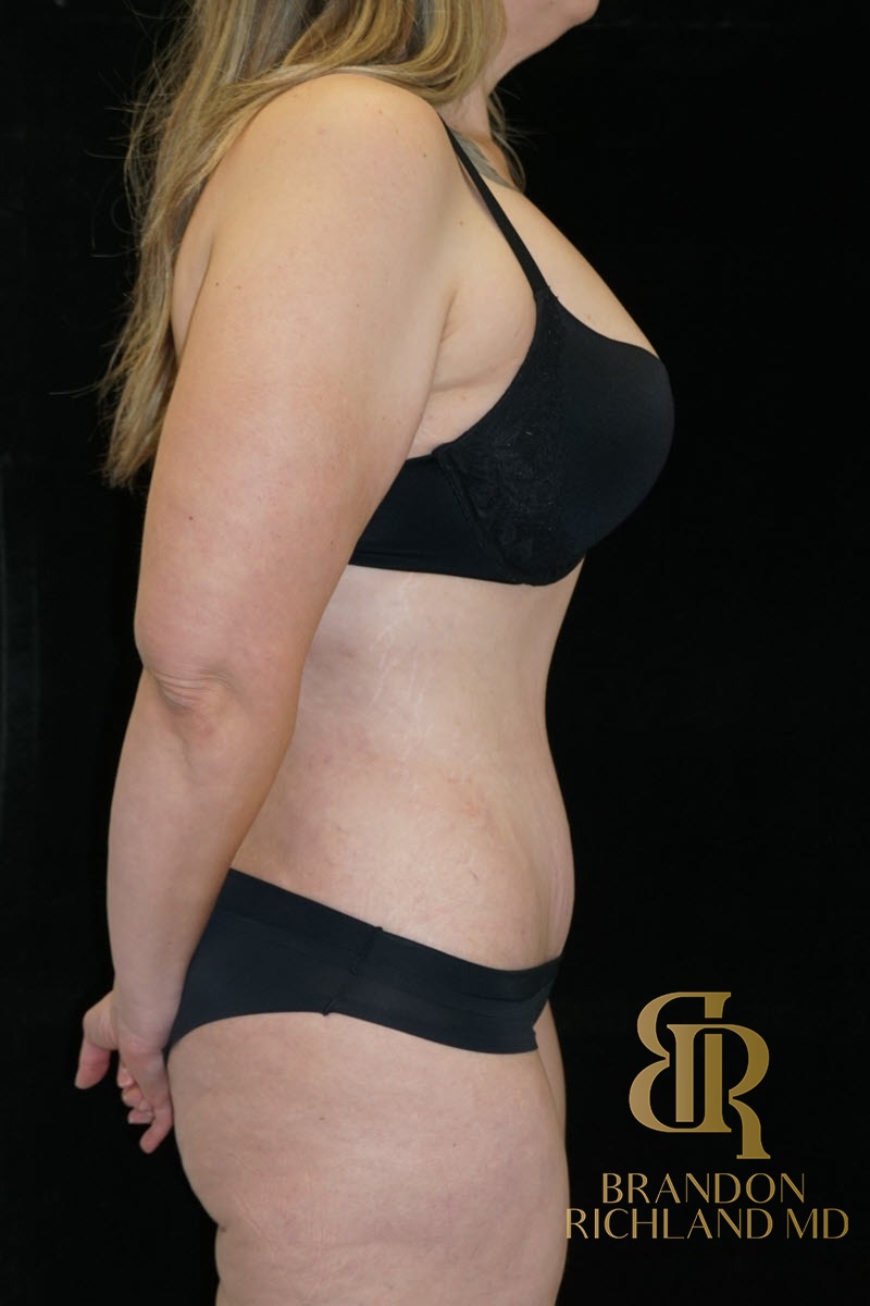 Tummy Tuck before and after, Patient 26 — Dr. Brandon Richland, Newport Beach