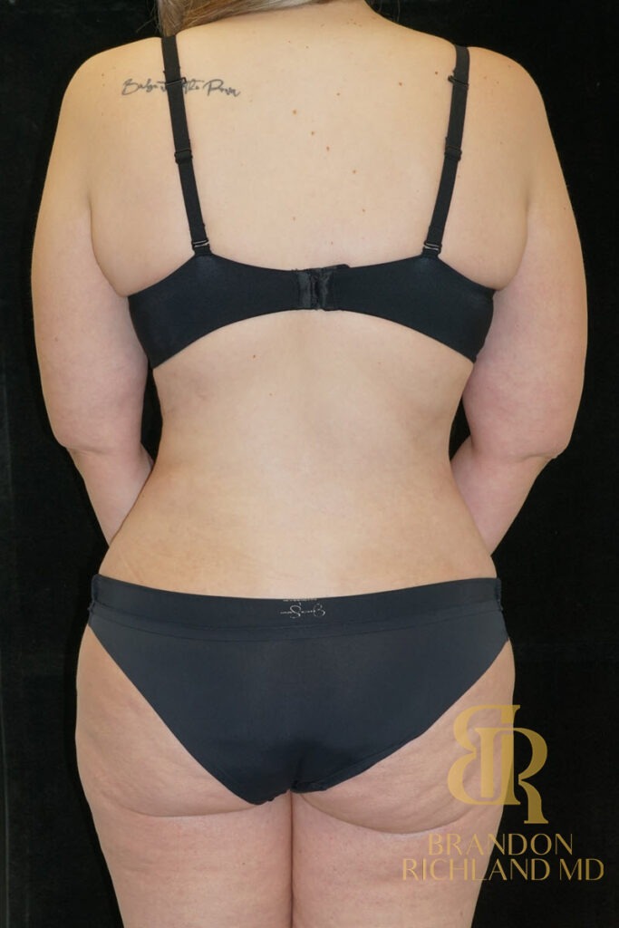 Tummy Tuck After, Patient 26, view 6 — Dr. Brandon Richland, Newport Beach