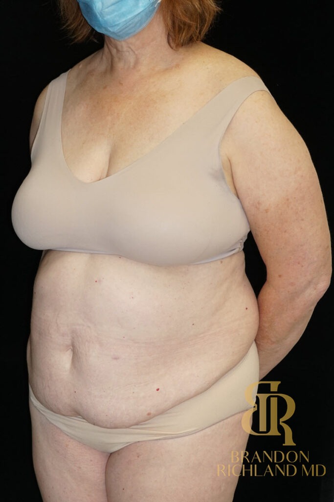Tummy Tuck Before, Patient 30, view 4 — Dr. Brandon Richland, Newport Beach