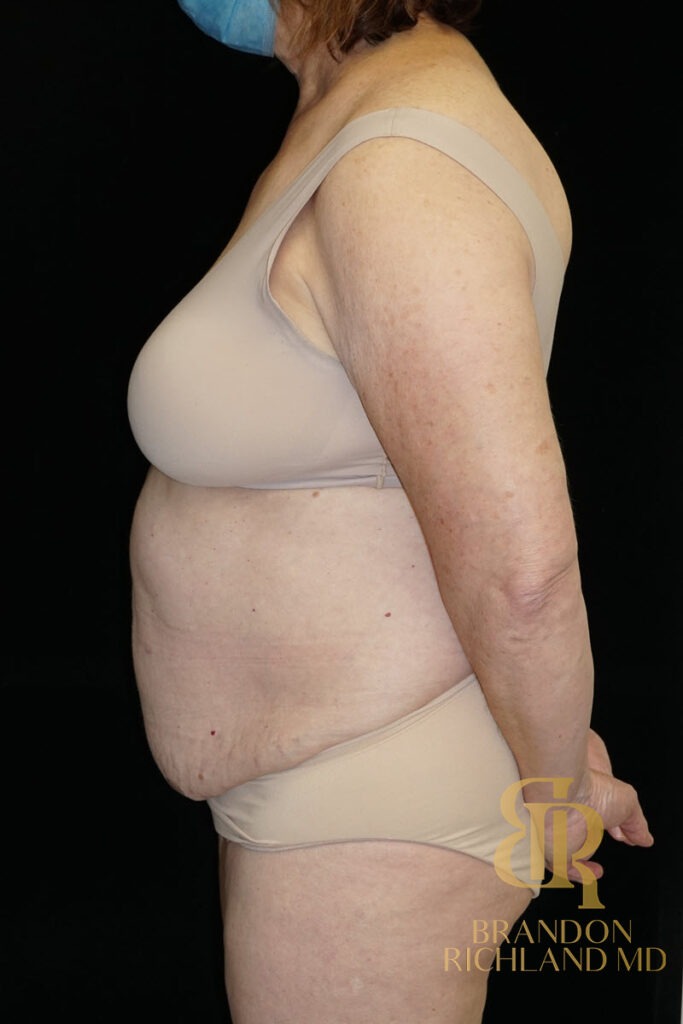 Tummy Tuck Before, Patient 30, view 5 — Dr. Brandon Richland, Newport Beach