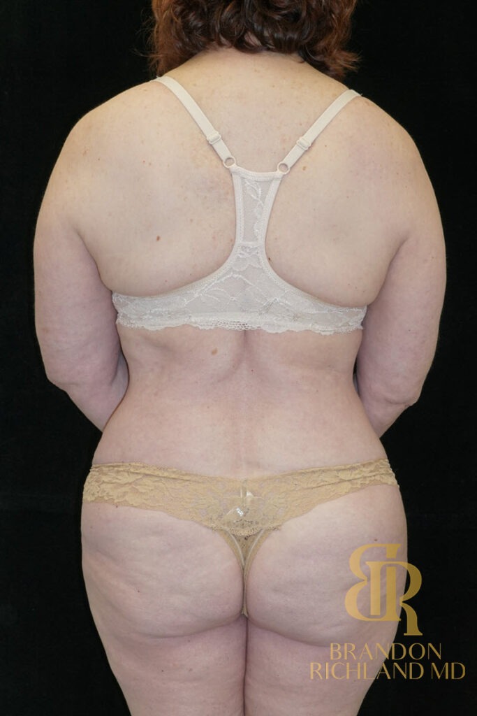 Tummy Tuck After, Patient 30, view 6 — Dr. Brandon Richland, Newport Beach