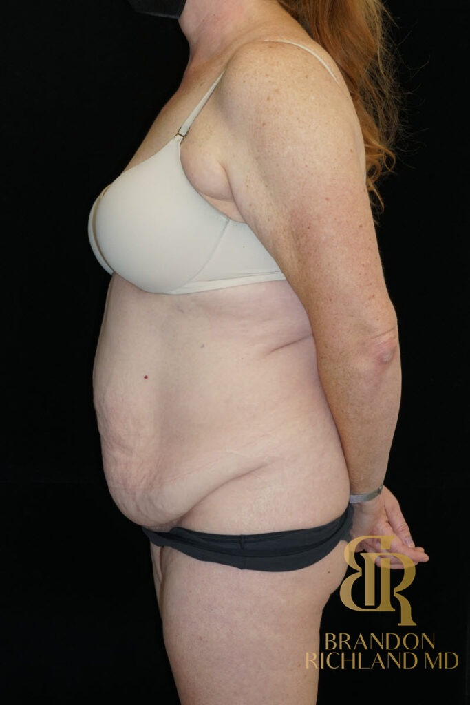 Tummy Tuck Before, Patient 34, view 5 — Dr. Brandon Richland, Newport Beach