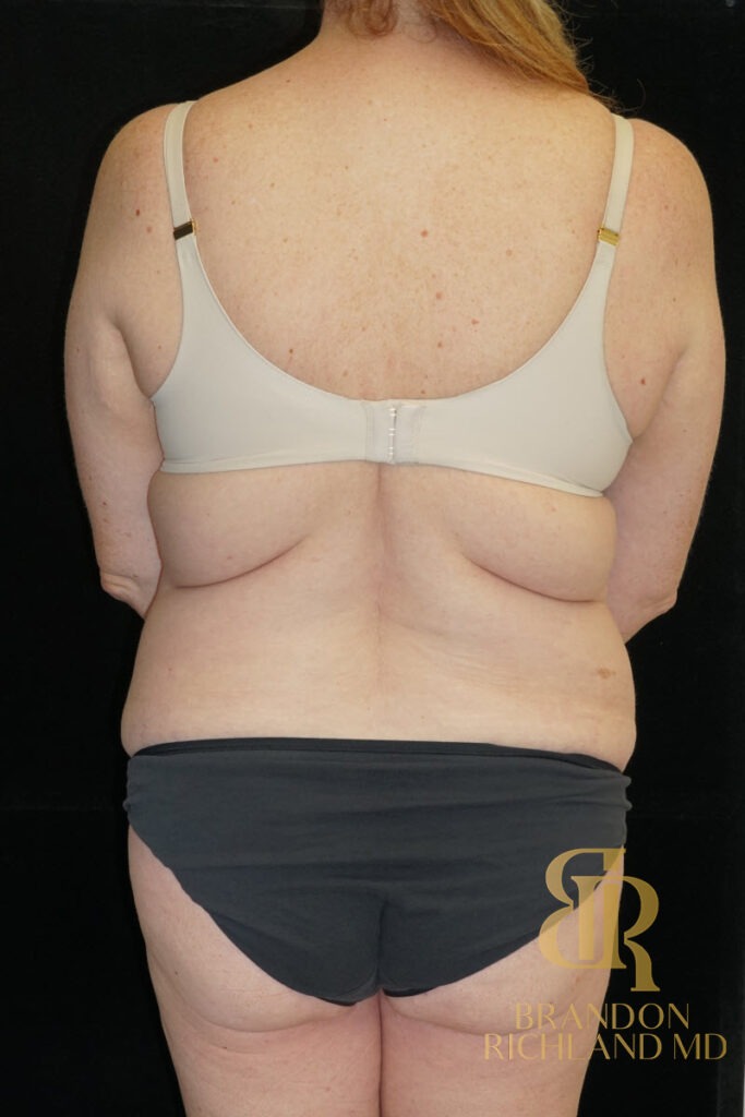 Tummy Tuck Before, Patient 34, view 6 — Dr. Brandon Richland, Newport Beach