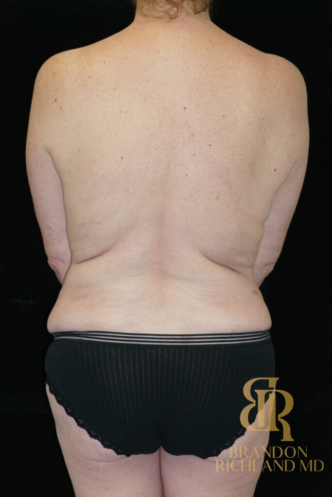 Tummy Tuck After, Patient 34, view 6 — Dr. Brandon Richland, Newport Beach