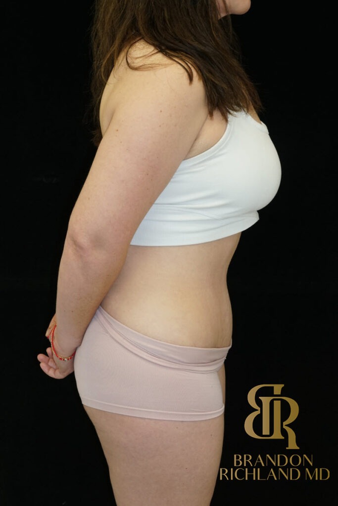 Tummy Tuck After, Patient 36, view 3 — Dr. Brandon Richland, Newport Beach