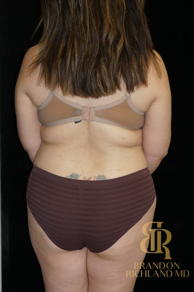 Tummy Tuck Before, Patient 36, view 6 — Dr. Brandon Richland, Newport Beach