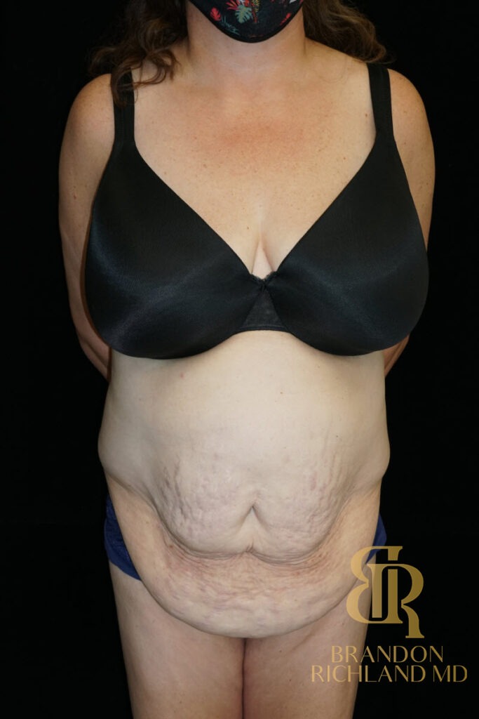 Tummy Tuck Before, Patient 38, view 1 — Dr. Brandon Richland, Newport Beach
