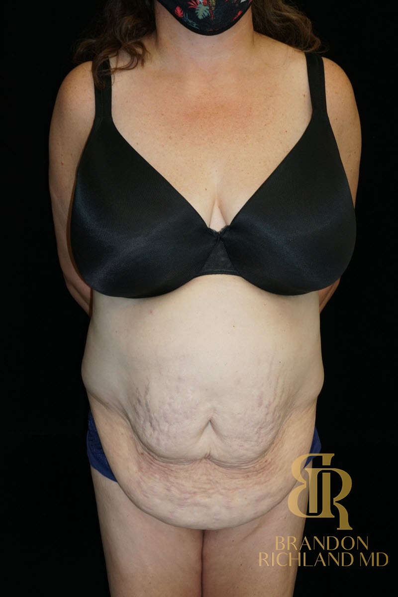 Tummy Tuck before and after, Patient 38 — Dr. Brandon Richland, Newport Beach