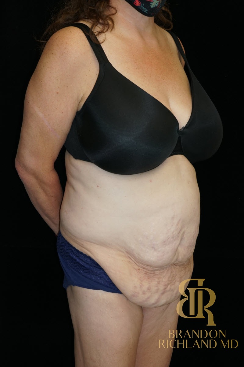 Tummy Tuck before and after, Patient 38 — Dr. Brandon Richland, Newport Beach
