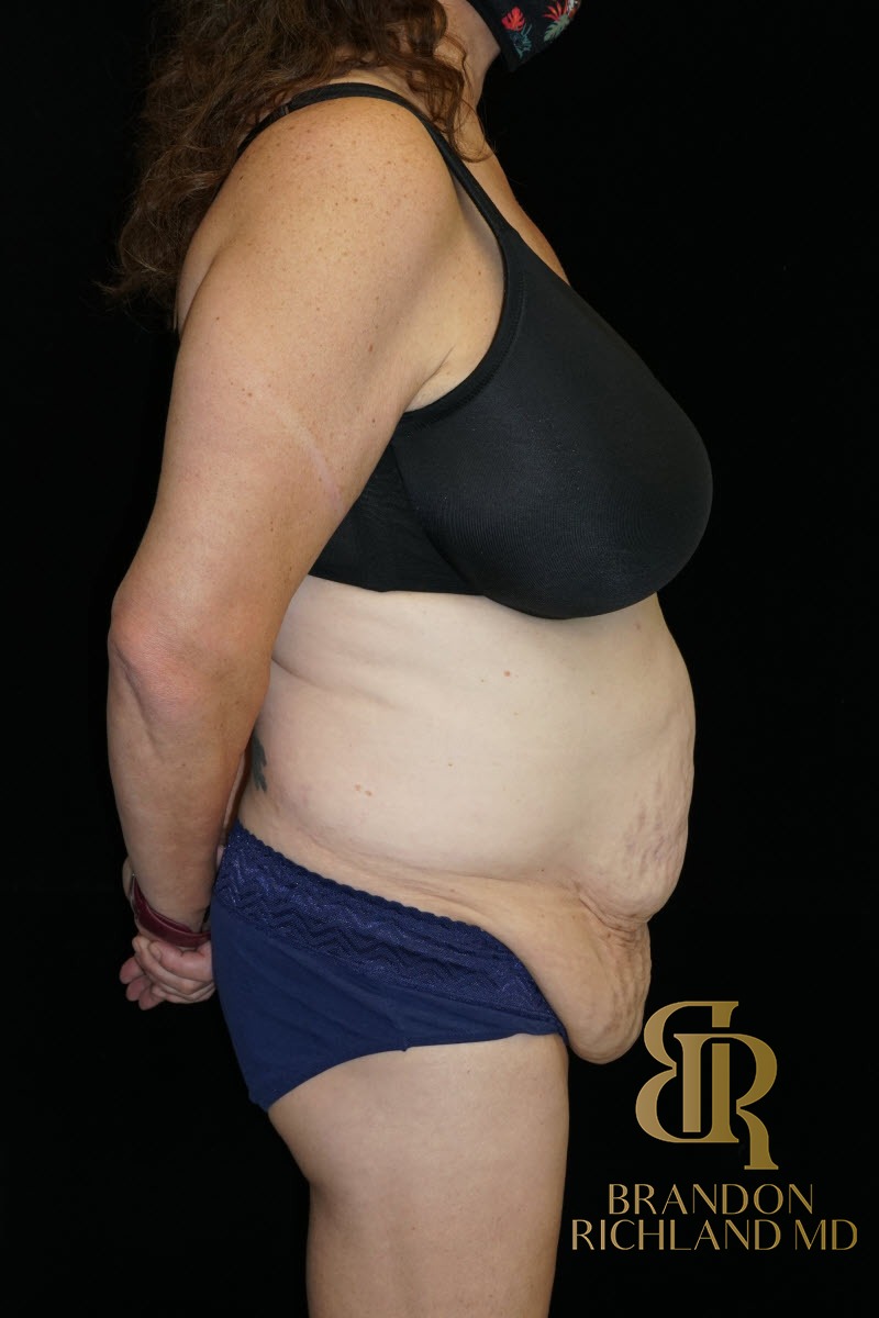 Tummy Tuck before and after, Patient 38 — Dr. Brandon Richland, Newport Beach