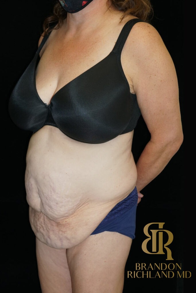 Tummy Tuck Before, Patient 38, view 4 — Dr. Brandon Richland, Newport Beach