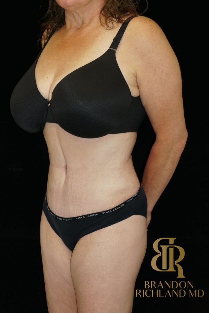 Tummy Tuck After, Patient 38, view 4 — Dr. Brandon Richland, Newport Beach