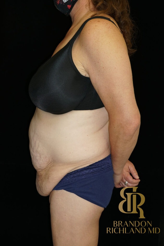 Tummy Tuck Before, Patient 38, view 5 — Dr. Brandon Richland, Newport Beach