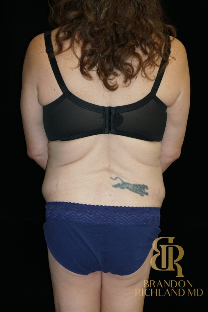 Tummy Tuck Before, Patient 38, view 6 — Dr. Brandon Richland, Newport Beach