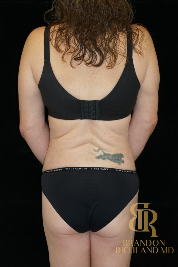 Tummy Tuck After, Patient 38, view 6 — Dr. Brandon Richland, Newport Beach