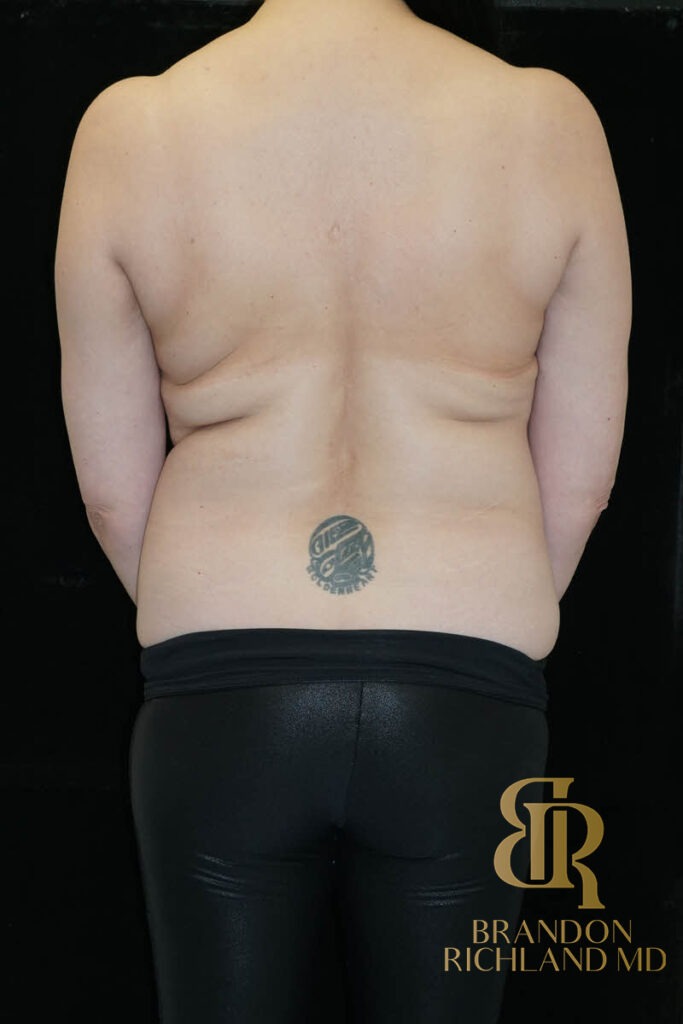 Tummy Tuck Before, Patient 39, view 6 — Dr. Brandon Richland, Newport Beach